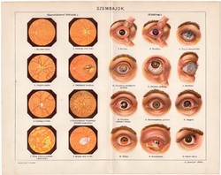 Szembajok, színes nyomat 1898, szem, gyulladás, orvos, gyógyászat, hályog, glaukóma, ép