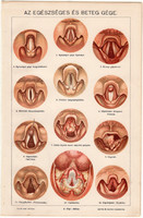 Az egészsége és beteg gége, litográfia 1895, színes nyomat, eredeti, magyar, Pallas, gyógyászat