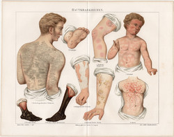 Bőrbetegségek, 1896, színes nyomat, német nyelvű, eredeti, litográfia, gyógyászat, bőr, ember, beteg