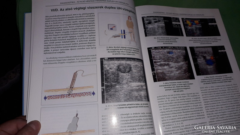 2004.Dr. Bihari Imre :Visszérbetegség és kezelése könyv a képek szerint Á + B KIADÓ